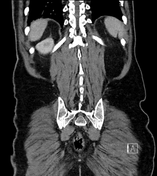Adrenal lymphoma (Radiopaedia 73730-84529 Coronal C+ portal venous phase 69).jpg