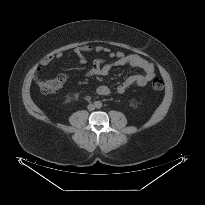 Adrenal myelolipoma (Radiopaedia 26278-26407 Axial non-contrast 41).jpg