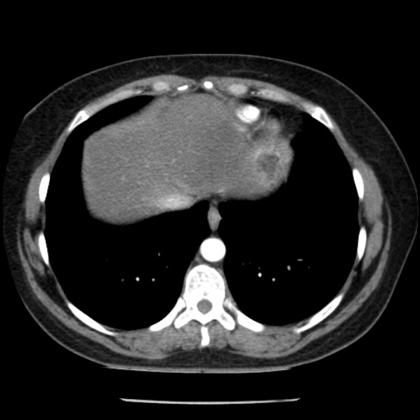 Adrenal myelolipoma (Radiopaedia 43401-46759 Axial C+ arterial phase 8).jpg