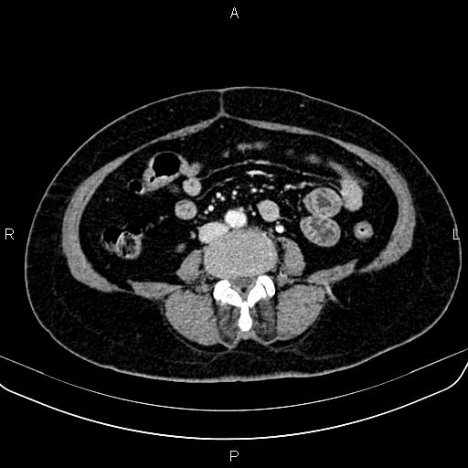 Adrenal myelolipoma (Radiopaedia 82742-96986 Axial renal cortical phase 105).jpg