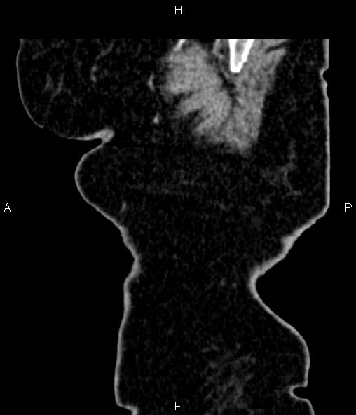 Adrenal myelolipoma (Radiopaedia 82742-96986 Sagittal renal cortical phase 9).jpg