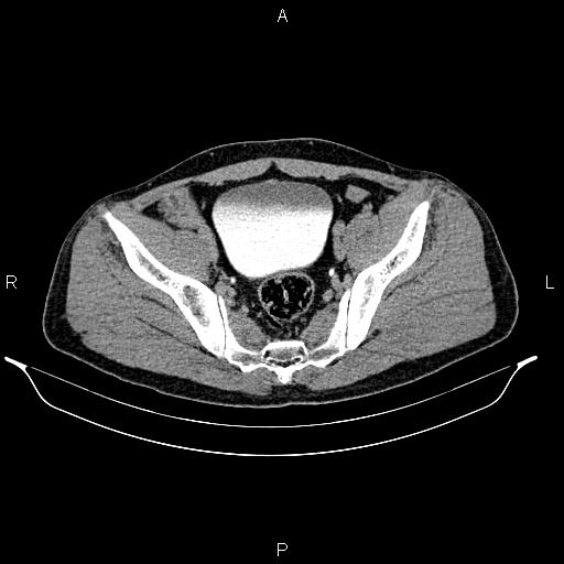 Adrenal myelolipoma (Radiopaedia 87794-104246 Axial renal excretory phase 85).jpg