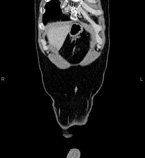 File:Adrenal myelolipoma (Radiopaedia 87794-104246 Coronal renal cortical phase 3).jpg