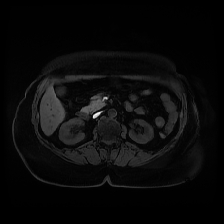 Adrenal myelolipoma - MRI (Radiopaedia 83249-97646 Axial T1 fat sat 44).jpg