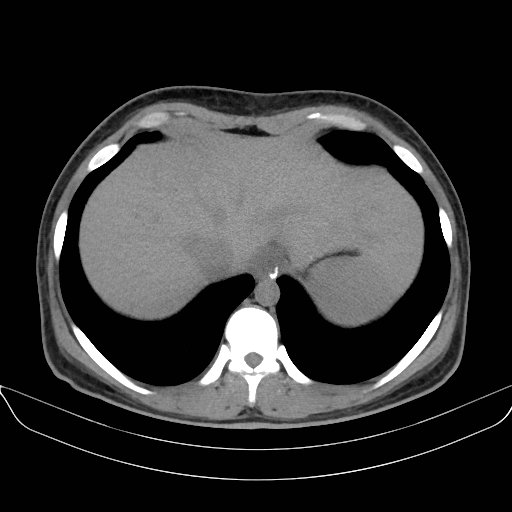 Adrenal myelolipoma - bilateral (Radiopaedia 74805-85810 Axial non-contrast 9).jpg