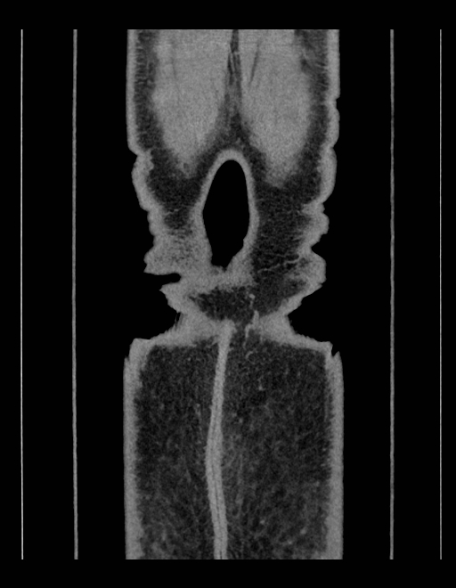 Adrenal myelolipoma - bilateral (Radiopaedia 74805-85810 Coronal C+ portal venous phase 32).jpg