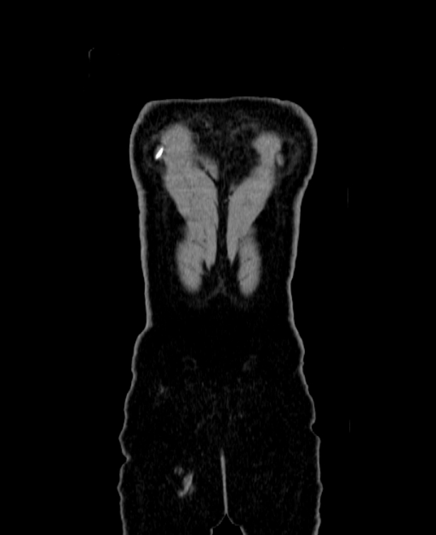 Adrenocortical carcinoma (Radiopaedia 80134-93438 Coronal C+ portal venous phase 168).jpg