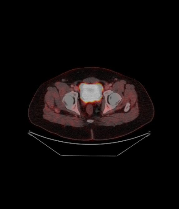 Adrenocortical carcinoma (Radiopaedia 80134-93440 ِAxial 247).jpg