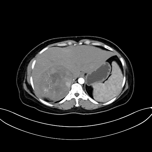 File:Adrenocortical carcinoma (Radiopaedia 87281-103569 Axial C+ arterial phase 18).jpg