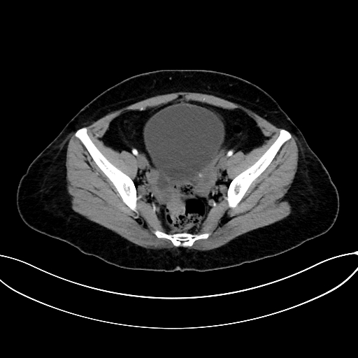 Adrenocortical carcinoma (Radiopaedia 87281-103569 Axial C+ arterial phase 73).jpg