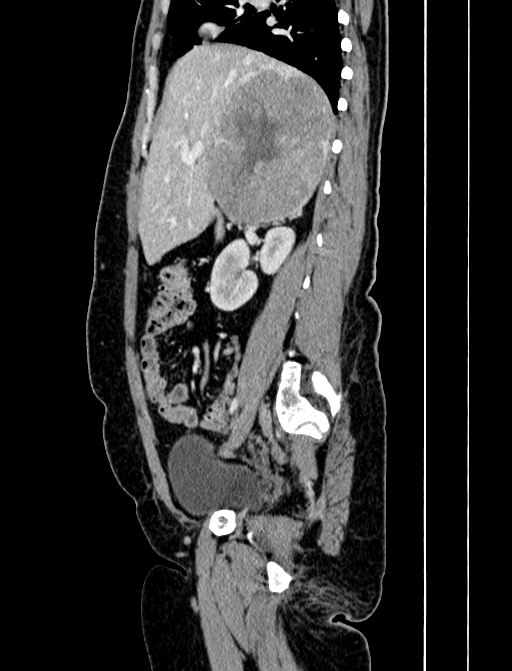 Adrenocortical carcinoma (Radiopaedia 87281-103569 Sagittal C+ portal venous phase 99).jpg