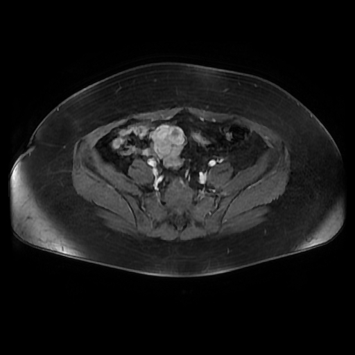 File:Adult granulosa cell tumor of the ovary (Radiopaedia 64991-73953 axial-T1 Fat sat post-contrast dynamic 67).jpg