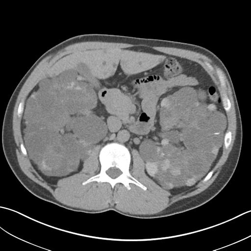 File:Adult polycystic kidney disease (Radiopaedia 47866-52626 Axial non-contrast 32).png