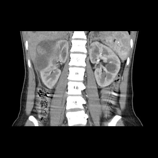 File:Adult polycystic kidney disease (Radiopaedia 48845-53876 Coronal renal cortical phase 24).jpg