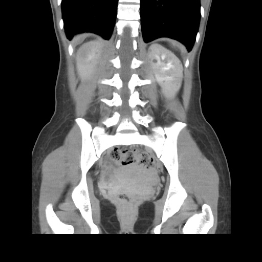 File:Adult polycystic kidney disease (Radiopaedia 48845-53876 Coronal renal excretory phase 31).jpg