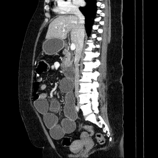 Afferent loop syndrome - secondary to incarcerated trocar site hernia (Radiopaedia 82959-97305 Sagittal C+ portal venous phase 86).jpg