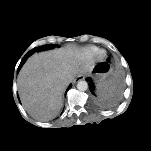 File:Aggressive lung cancer with cardiac metastases, pulmonary artery tumor thrombus, and Budd-Chiari (Radiopaedia 60320-67981 A 47).jpg