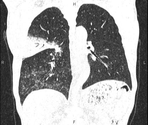 Air bronchogram in pneumonia (Radiopaedia 85719-101512 Coronal lung window 37).jpg