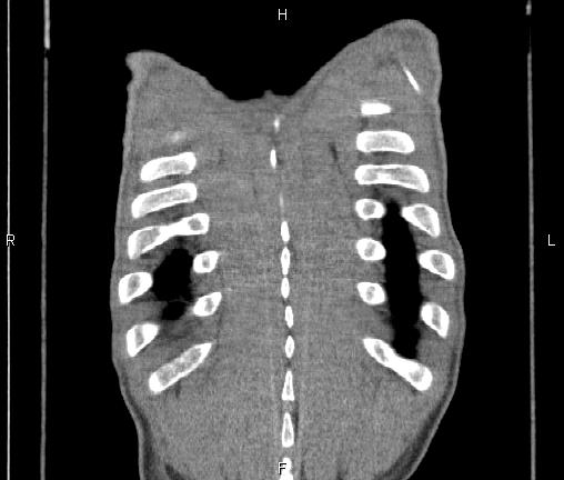Air bronchogram in pneumonia (Radiopaedia 85719-101512 Coronal non-contrast 58).jpg