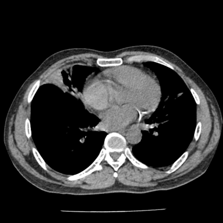 Airway foreign body in adult (Radiopaedia 85907-101779 Axial liver window 115).jpg