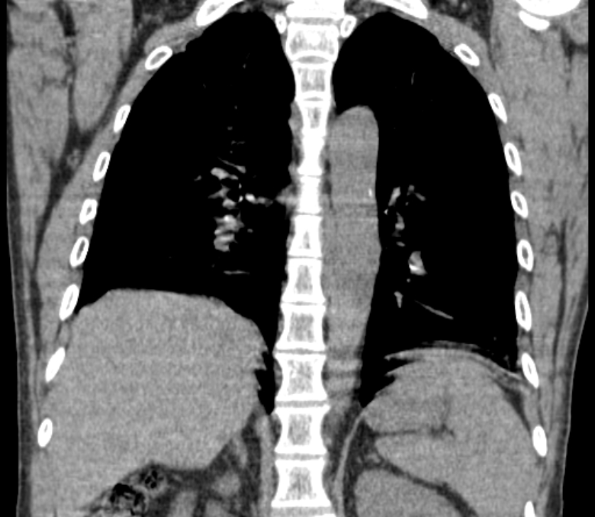 Airway foreign body in adult (Radiopaedia 85907-101779 Coronal liver window 178).jpg
