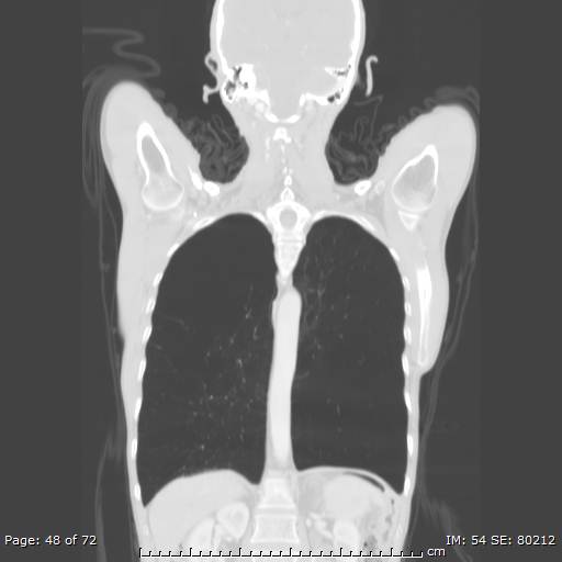 Alpha-1-antitrypsin deficiency (Radiopaedia 50561-55987 Coronal lung window 46).jpg