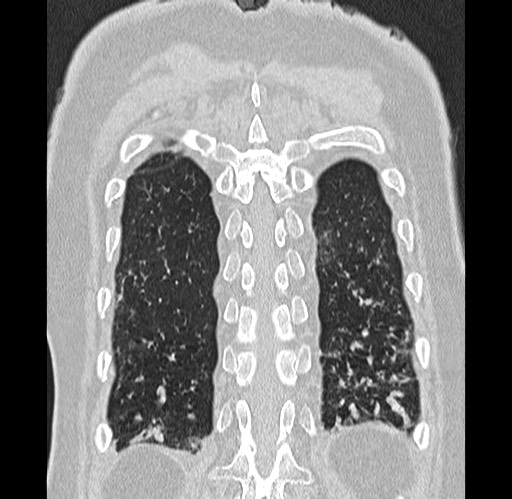 Alpha-1-antitrypsin deficiency (Radiopaedia 72058-82557 Coronal lung window 89).jpg