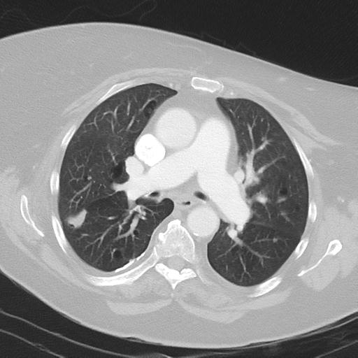 Alveolar hemorrhage and possible lymphocytic interstitial pneumonitis in systemic lupus erythematosus (Radiopaedia 28582-28839 Axial lung window 22).jpg