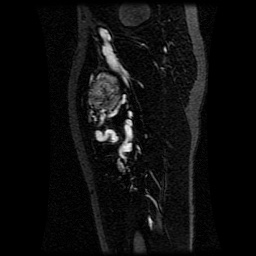 Alveolar soft part sarcoma (Radiopaedia 64501-73678 D 61).jpg