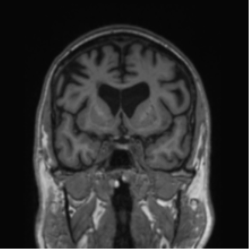 File:Alzheimer's disease- with Gerstmann syndrome and dressing apraxia (Radiopaedia 54882-61150 Coronal T1 57).png
