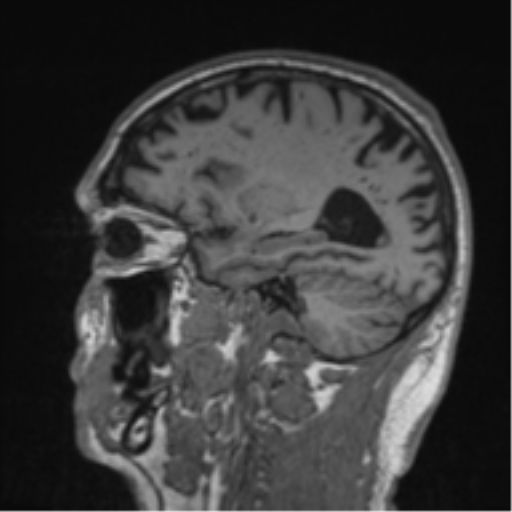 Alzheimer's disease- with Gerstmann syndrome and dressing apraxia (Radiopaedia 54882-61150 Sagittal T1 50).png