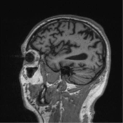 Alzheimer's disease- with Gerstmann syndrome and dressing apraxia (Radiopaedia 54882-61150 Sagittal T1 55).png