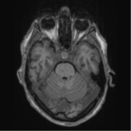 File:Alzheimer's disease- with apraxia (Radiopaedia 54763-61011 Axial T1 24).png