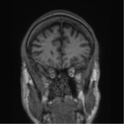 File:Alzheimer's disease- with apraxia (Radiopaedia 54763-61011 Coronal T1 70).png