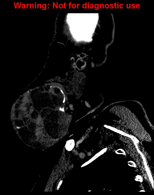 Ameloblastoma (Radiopaedia 33126-34164 F 13).jpg