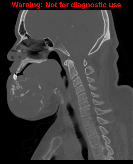 Ameloblastoma (Radiopaedia 33126-34164 Sagittal bone window 40).jpg