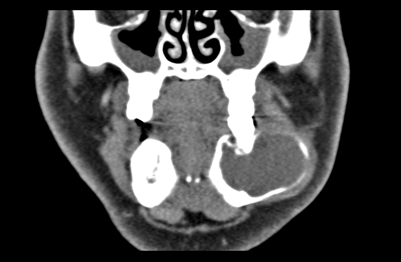 File:Ameloblastoma (Radiopaedia 33677-34806 Coronal non-contrast 21).png