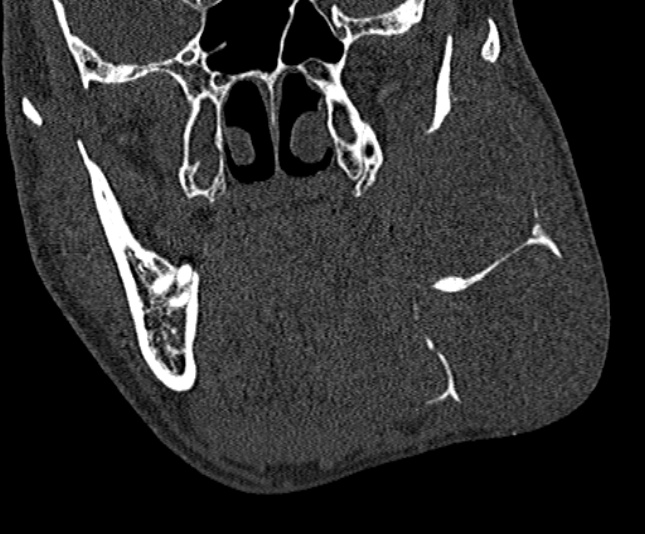Ameloblastoma (Radiopaedia 51921-57766 Coronal bone window 118).jpg