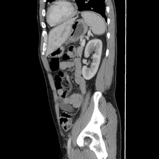 Amoebic liver abscesses (Radiopaedia 55536-62009 C 45).jpg