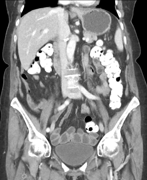 Ampullary adenocarcinoma (Radiopaedia 34013-35237 E 26).png