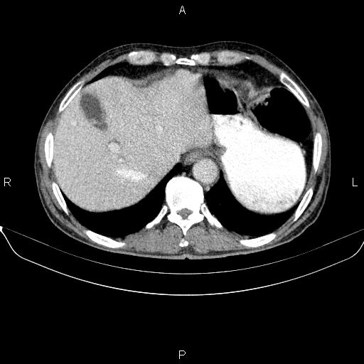 File:Ampullary adenocarcinoma (Radiopaedia 86093-102032 A 11).jpg