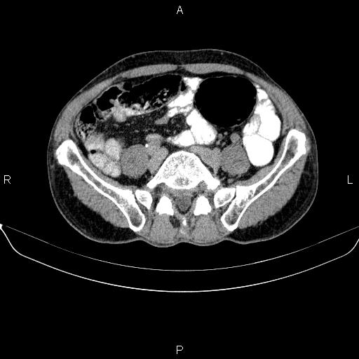 Ampullary adenocarcinoma (Radiopaedia 86093-102032 Axial C+ delayed 74).jpg