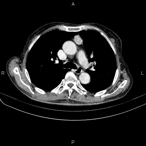 Ampullary adenocarcinoma (Radiopaedia 86093-102033 B 28).jpg