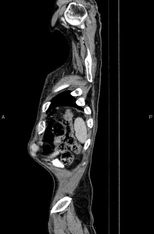 Ampullary adenocarcinoma (Radiopaedia 86093-102033 E 89).jpg