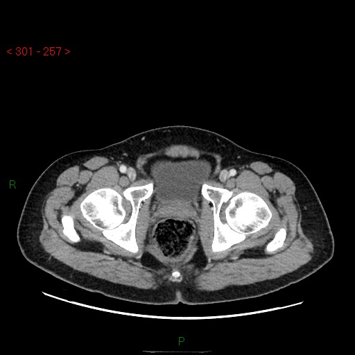 Ampullary carcinoma (Radiopaedia 56396-63056 C 99).jpg