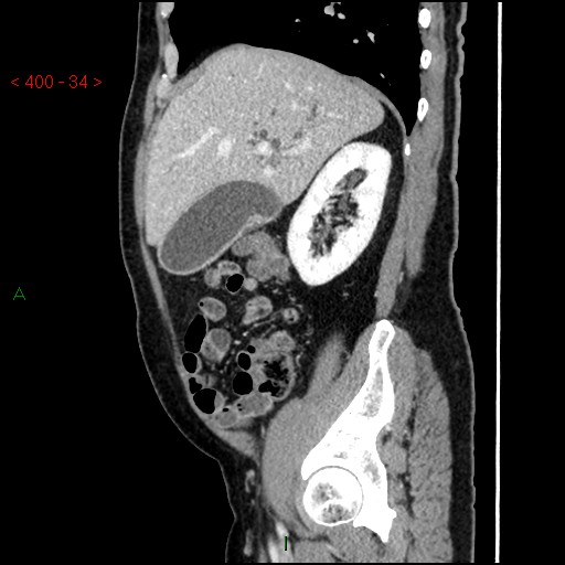 Ampullary carcinoma (Radiopaedia 56396-63056 D 33).jpg