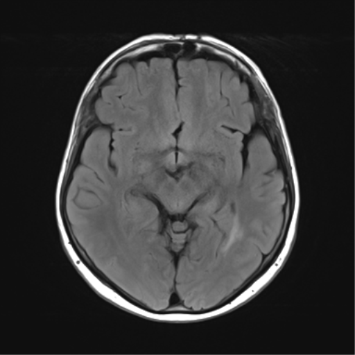 File:Anaplastic astrocytoma (Radiopaedia 86943-103160 Axial FLAIR 13).png