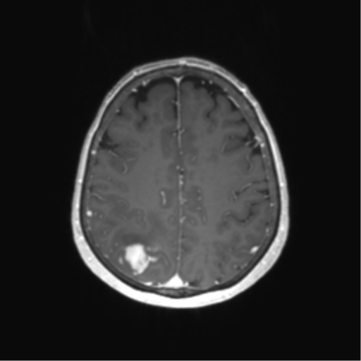 File:Anaplastic astrocytoma (Radiopaedia 86943-103160 Axial T1 C+ 56).png