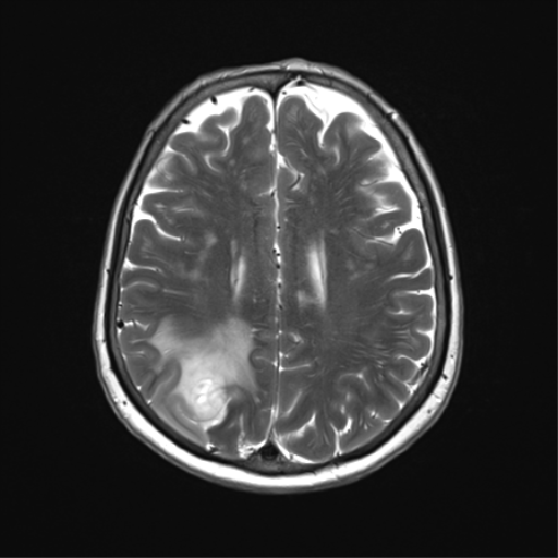 File:Anaplastic astrocytoma (Radiopaedia 86943-103160 Axial T2 26).png