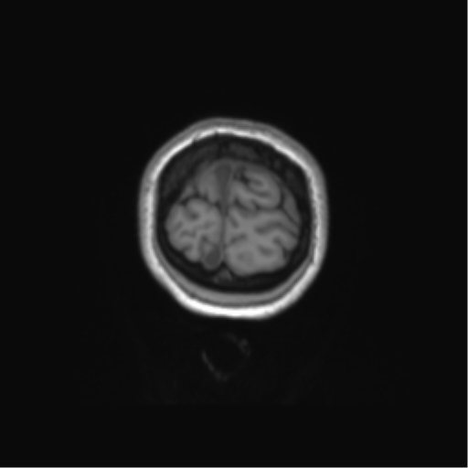 Anaplastic astrocytoma IDH mutant (Radiopaedia 50046-55341 Coronal T1 6).png